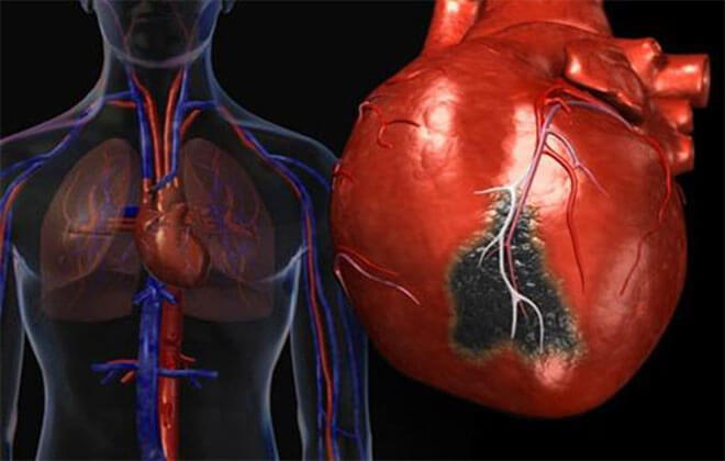 Абдомінальна форма інфаркту міокарда: симптоми