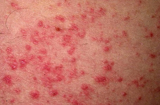 Алергічний дерматит: симптоми