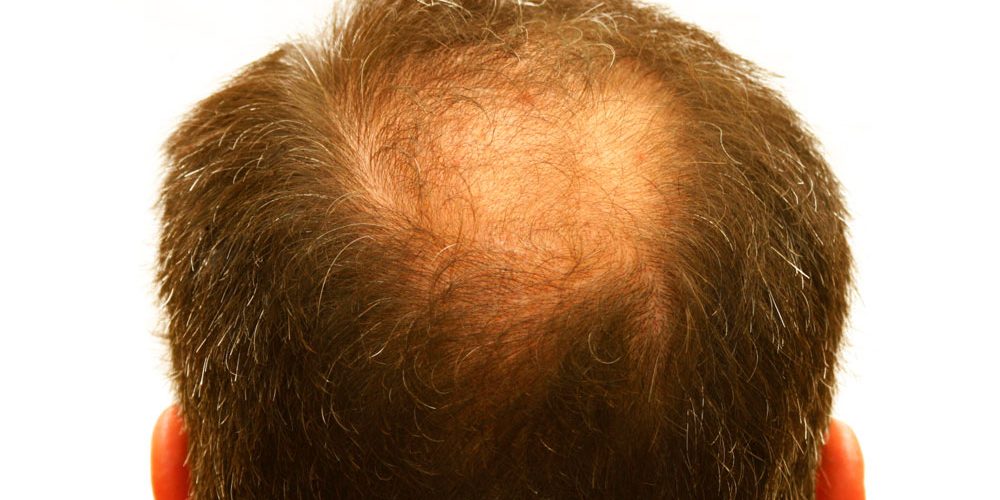 Алопеция или выпадение волос