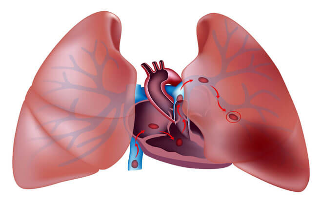 Аневризма легеневої артерії: симптоми