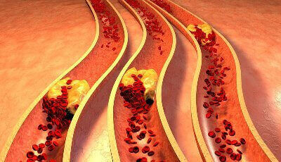 Атеросклероз судин нижніх кінцівок