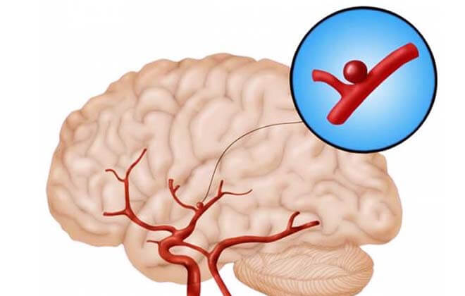 Ендоваскулярна емболізація аневризми головного мозку: судин