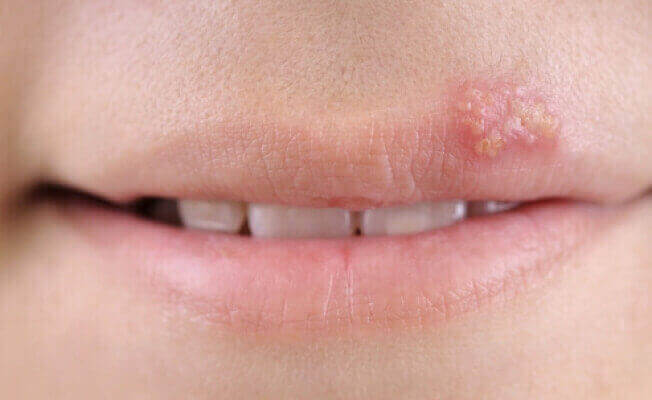 Герпес на губах: лікування в домашніх умовах