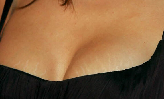 Через що з'являються розтяжки на грудях і як їх розпізнати?