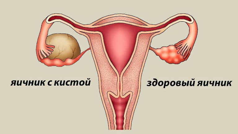 Кіста правого і лівого яєчника у жінок: симптоми