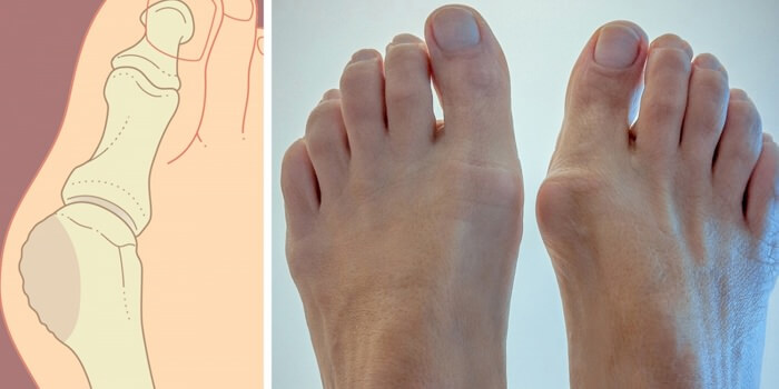 Кісточка на нозі (вальгусна деформація): лікування
