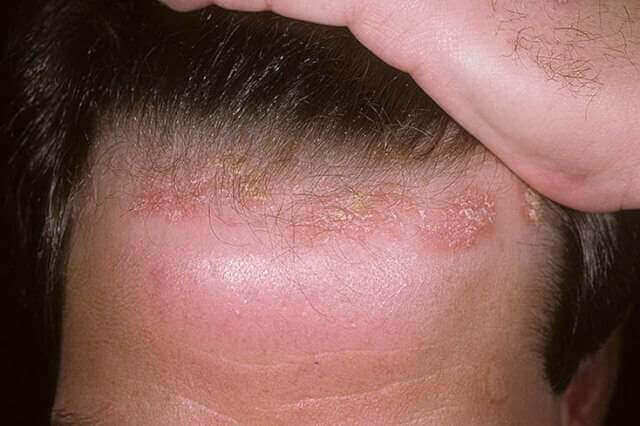 Псоріаз на волосистій частині голови: симптоми і лікування народними засобами
