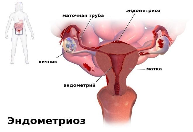 Кровотеча при ендометріозі: маткові