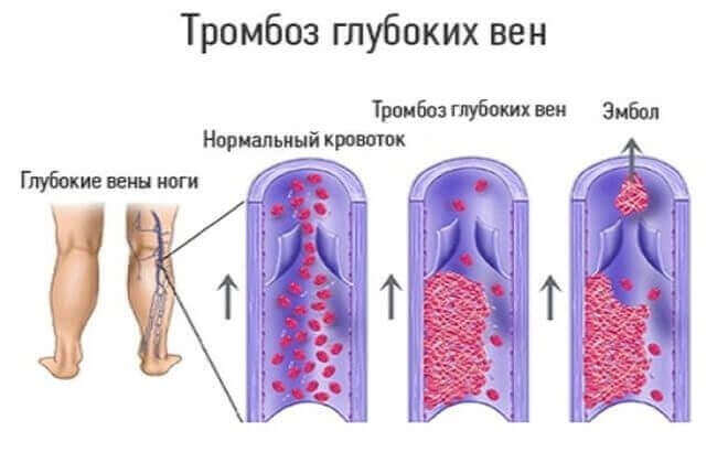 Тромбоз глибоких вен нижніх кінцівок: симптоми