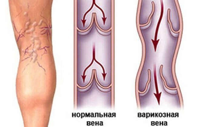 Внутрішній варикоз на ногах: симптоми