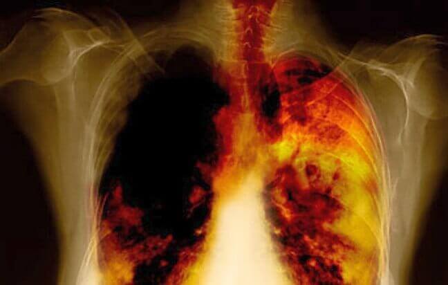 Рак легенів: причини