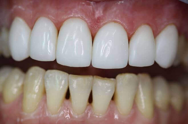 Реставрація зубів - корекція і відновлення функцій