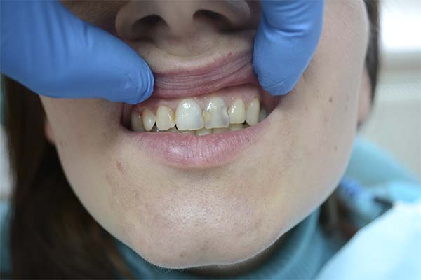 Сонник карієс на зубах: до чого сниться і що означає сон про зубний карієс