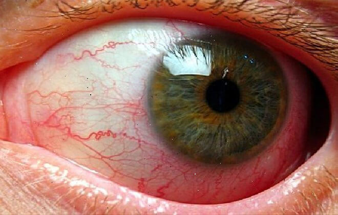 Звуження судин очного дна: причини
