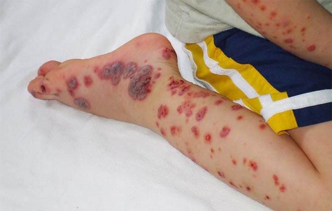 Тромбоцитопенічна пурпура у дітей: хвороба Верльгофа