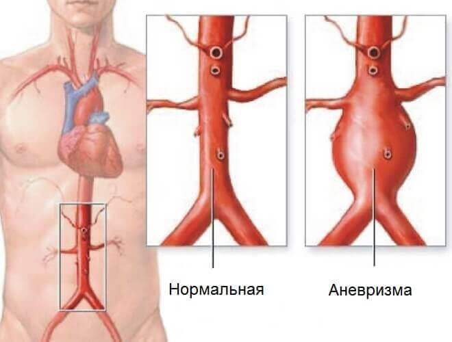 Аневризма аорти черевної порожнини: симптоми