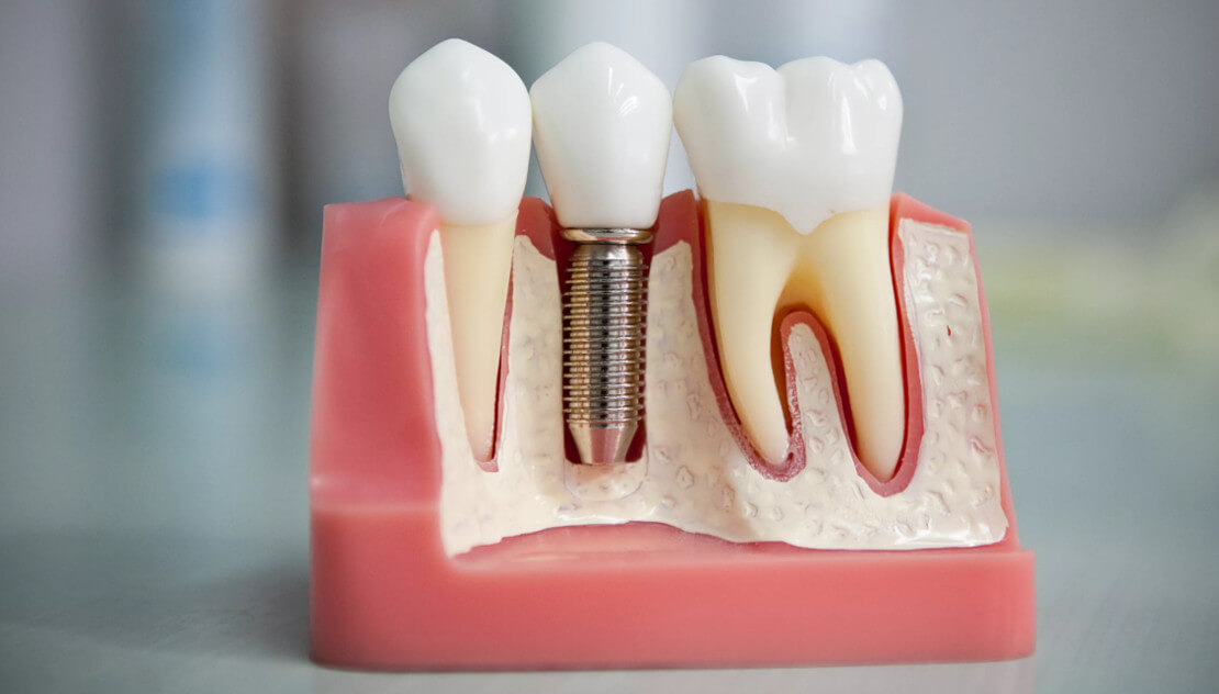 імплантація зубів