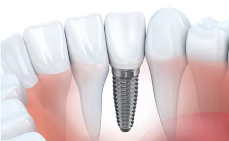 Какие минусы имплантации зубов?