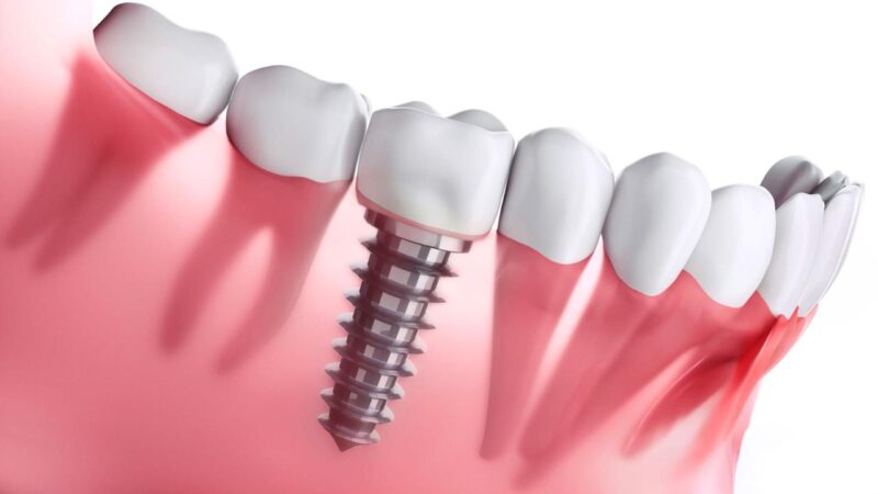 Повна імплантація зубів